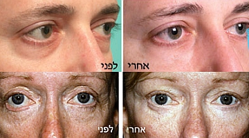 ניתוח עפעפיים לתיקון שקיות מתחת לעיניים
